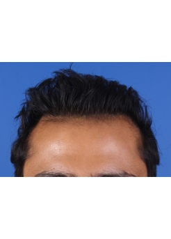 After Hair Transplant&nbsp;2 Sessions (Areas)
